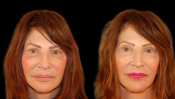 Upper Eyelid Surgery Before & After Gallery - Patient 266643 - Image 1