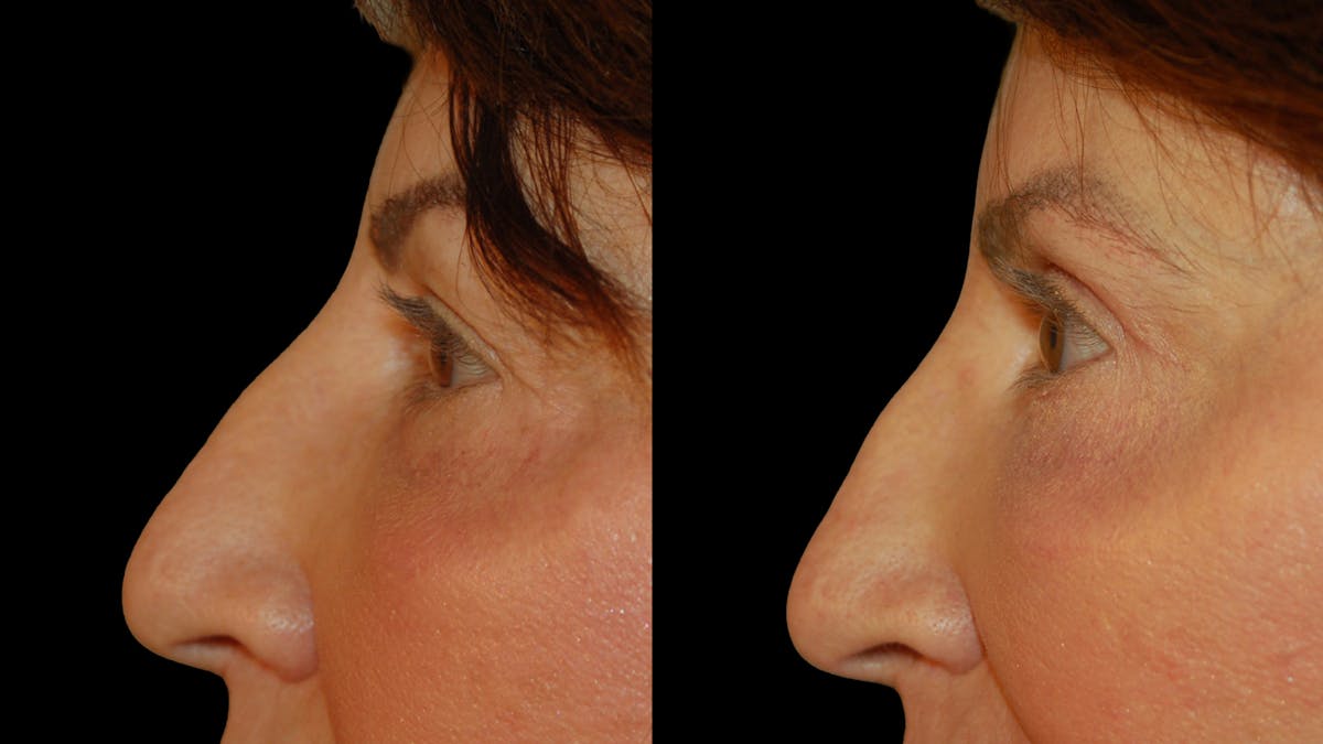 Upper Eyelid Surgery Before & After Gallery - Patient 266643 - Image 2