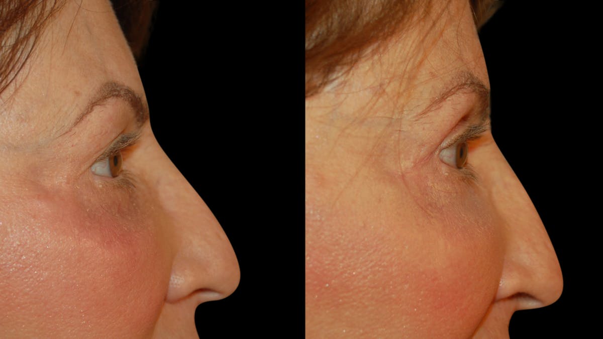 Upper Eyelid Surgery Before & After Gallery - Patient 266643 - Image 3