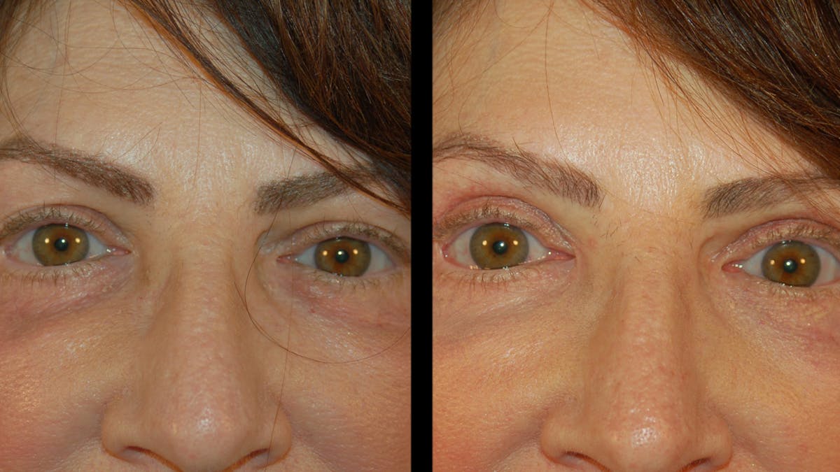 Upper Eyelid Surgery Before & After Gallery - Patient 266643 - Image 4