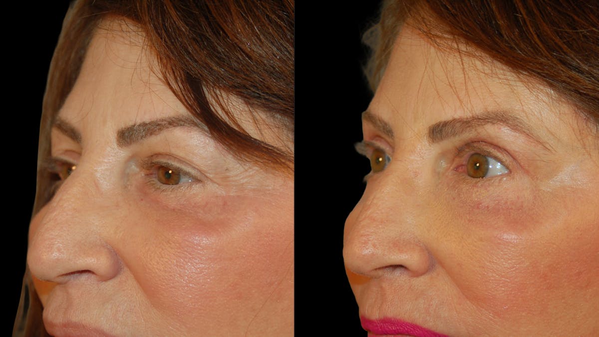 Upper Eyelid Surgery Before & After Gallery - Patient 266643 - Image 5