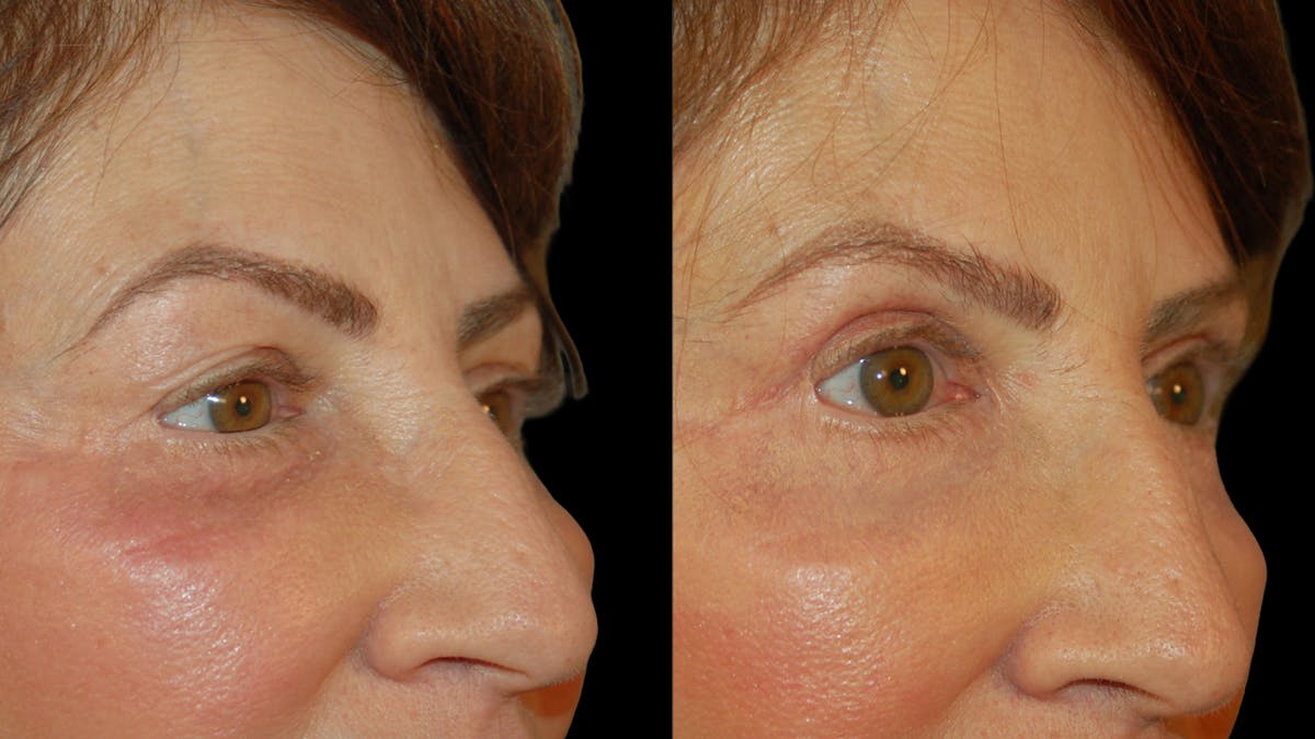 Upper Eyelid Surgery Before & After Gallery - Patient 266643 - Image 6