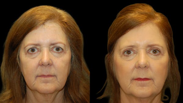 Upper Eyelid Surgery Before & After Gallery - Patient 177988 - Image 1