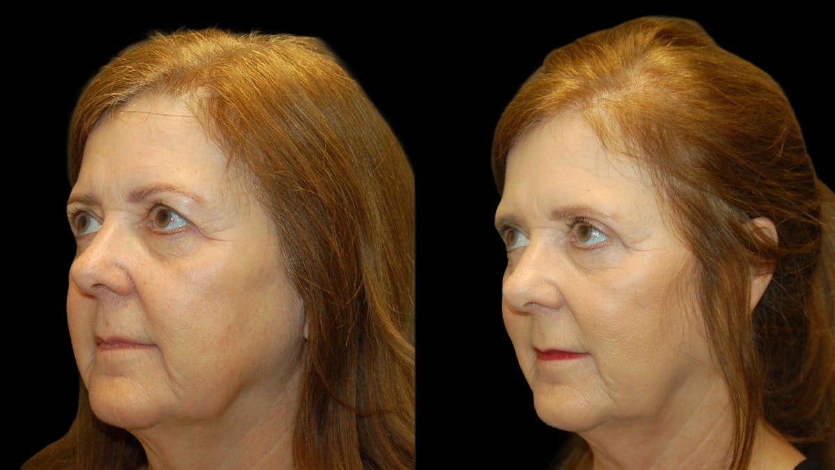 Upper Eyelid Surgery Before & After Gallery - Patient 177988 - Image 2