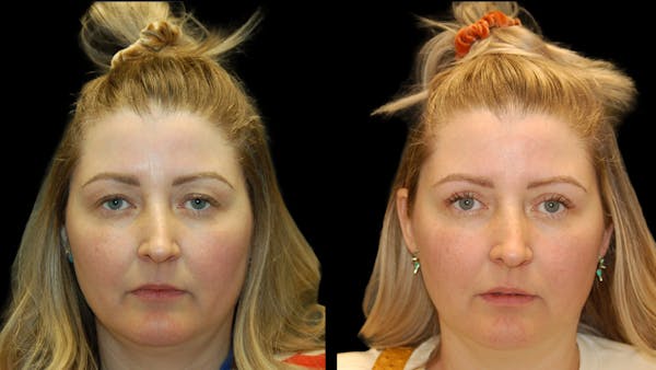 Upper Eyelid Surgery Before & After Gallery - Patient 264655 - Image 1