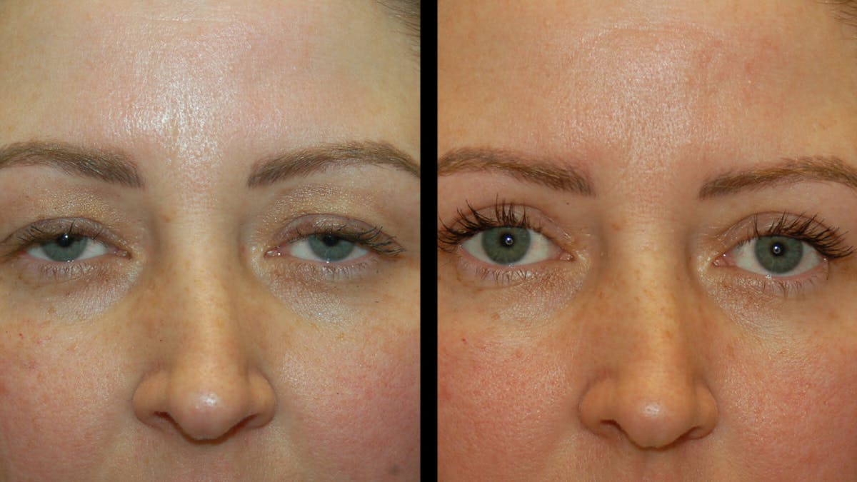 Upper Eyelid Surgery Before & After Gallery - Patient 264655 - Image 6