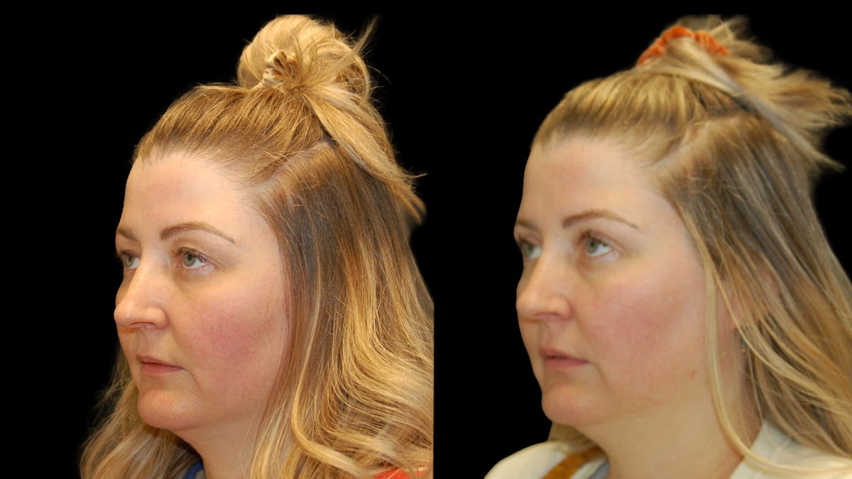Upper Eyelid Surgery Before & After Gallery - Patient 264655 - Image 2