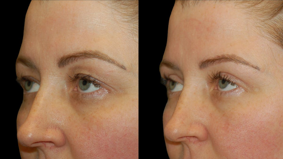 Upper Eyelid Surgery Before & After Gallery - Patient 264655 - Image 7