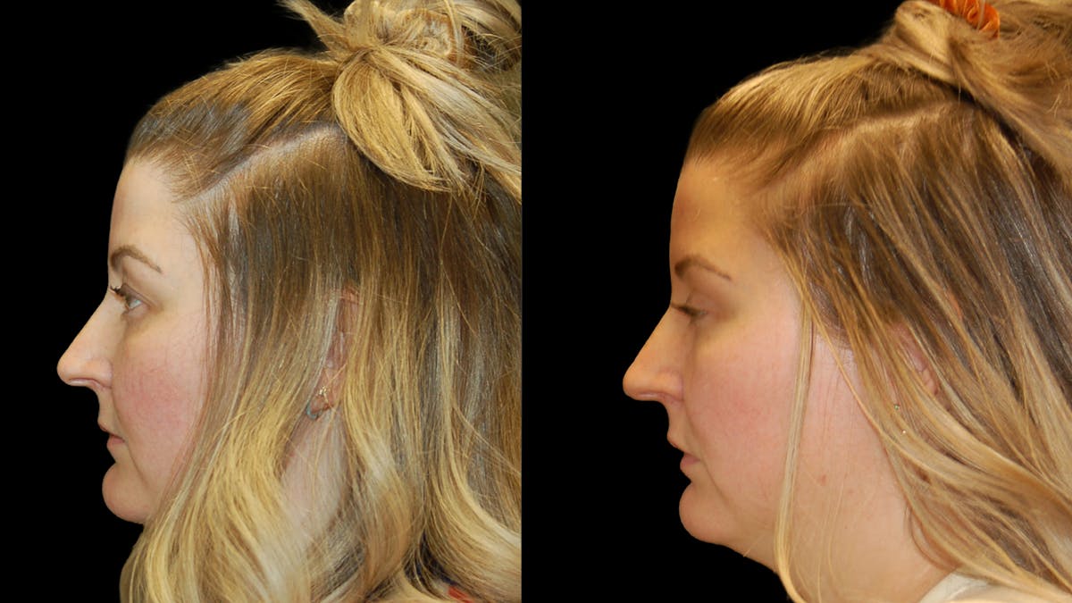 Upper Eyelid Surgery Before & After Gallery - Patient 264655 - Image 3