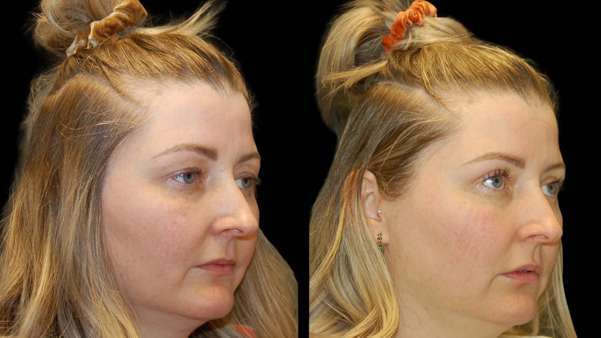 Upper Eyelid Surgery Before & After Gallery - Patient 264655 - Image 4