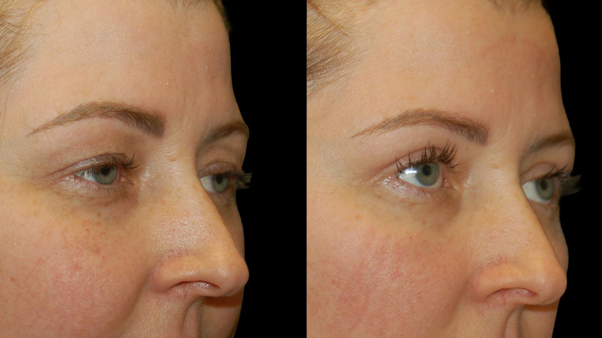 Upper Eyelid Surgery Before & After Gallery - Patient 264655 - Image 8