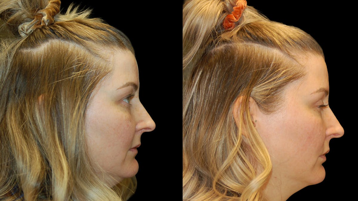 Upper Eyelid Surgery Before & After Gallery - Patient 264655 - Image 5