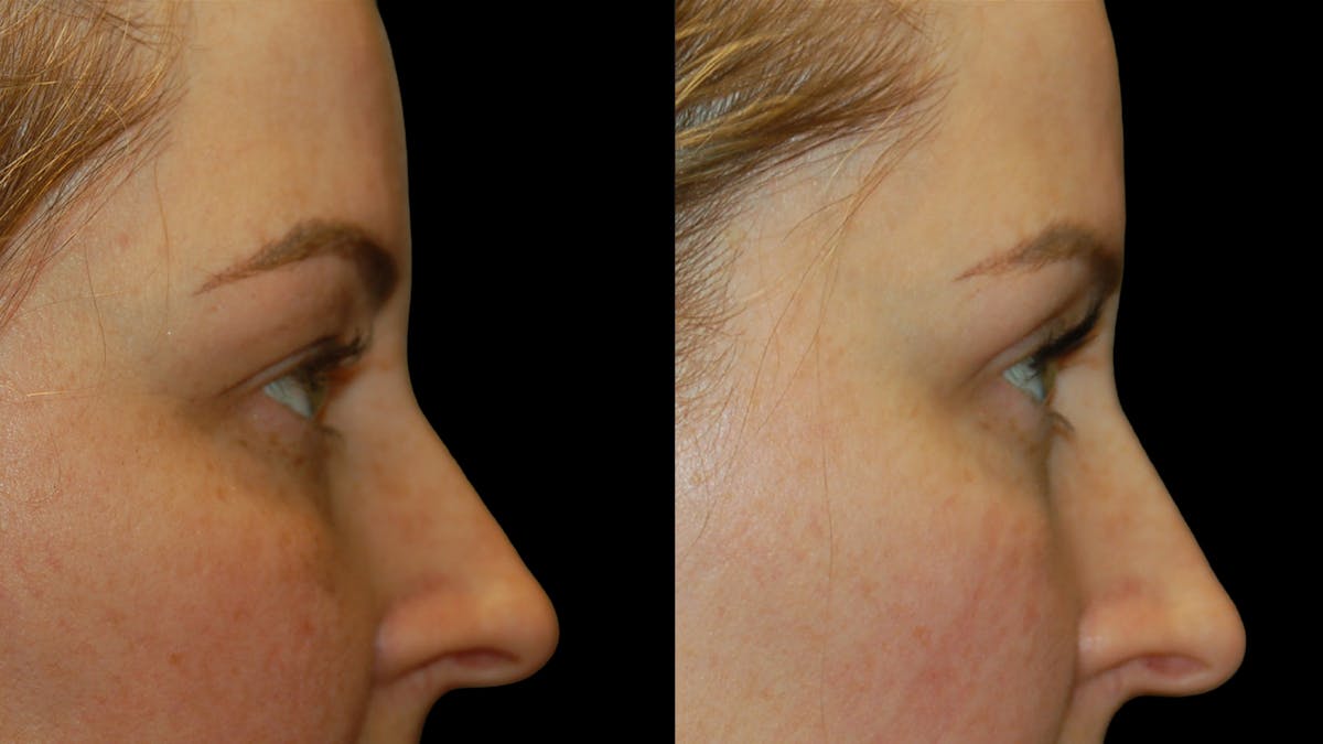 Upper Eyelid Surgery Before & After Gallery - Patient 264655 - Image 9