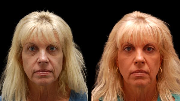 Upper & Lower Eyelid Surgery Before & After Gallery - Patient 176374 - Image 1