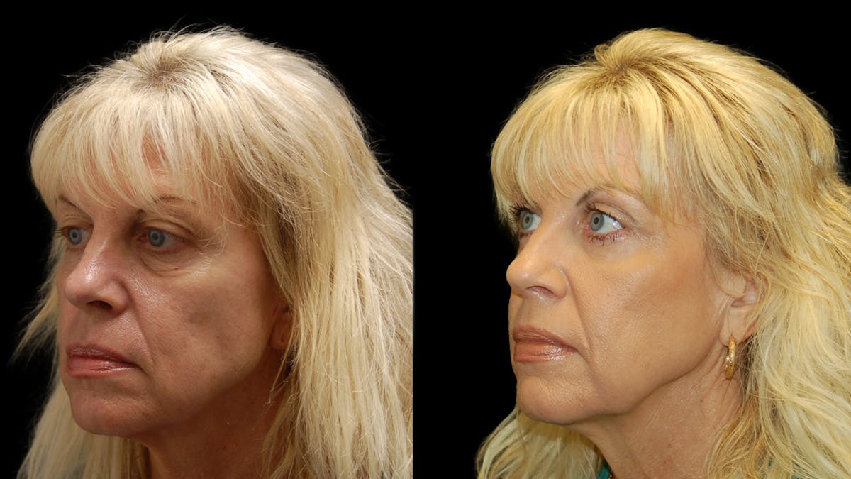Upper & Lower Eyelid Surgery Before & After Gallery - Patient 176374 - Image 2