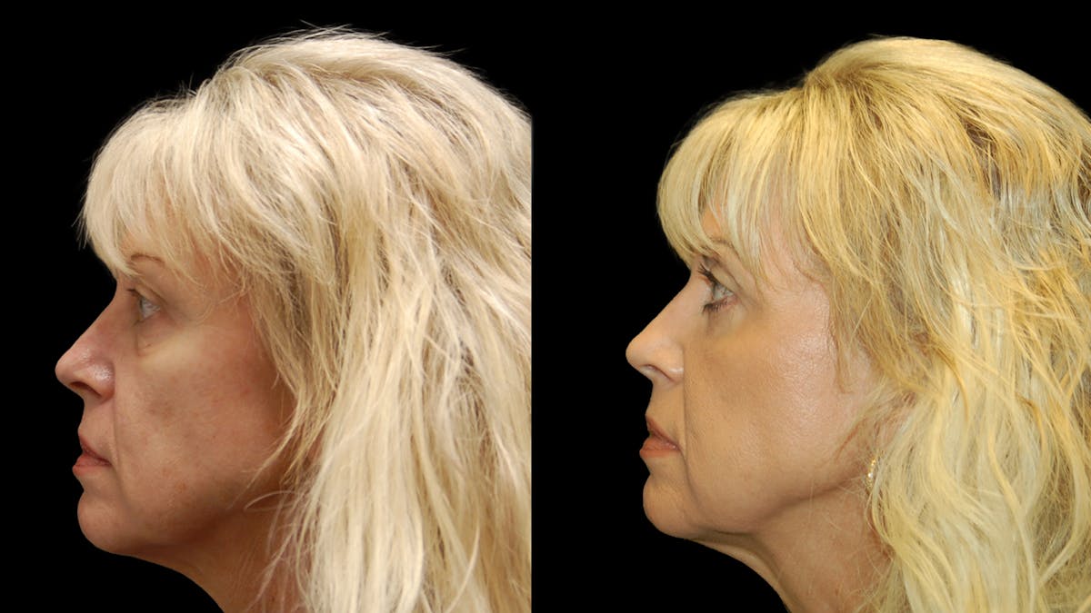 Upper & Lower Eyelid Surgery Before & After Gallery - Patient 176374 - Image 3