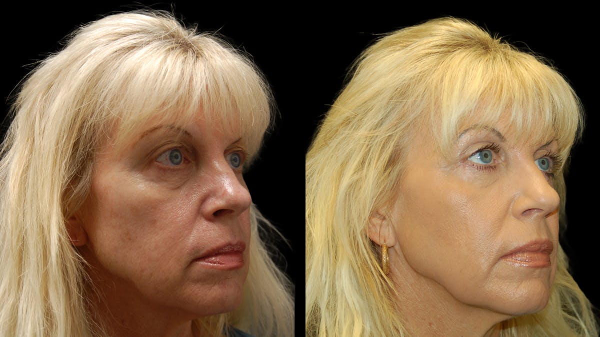 Upper & Lower Eyelid Surgery Before & After Gallery - Patient 176374 - Image 4