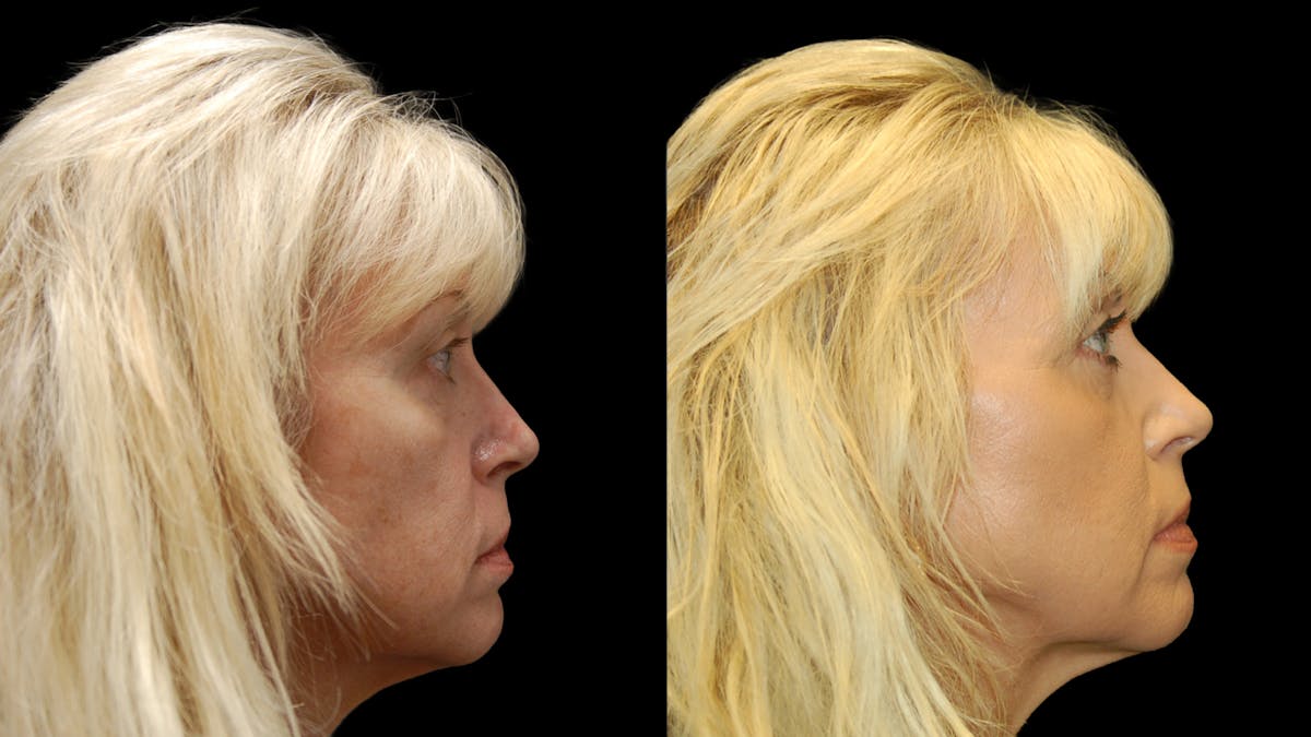 Upper & Lower Eyelid Surgery Before & After Gallery - Patient 176374 - Image 5