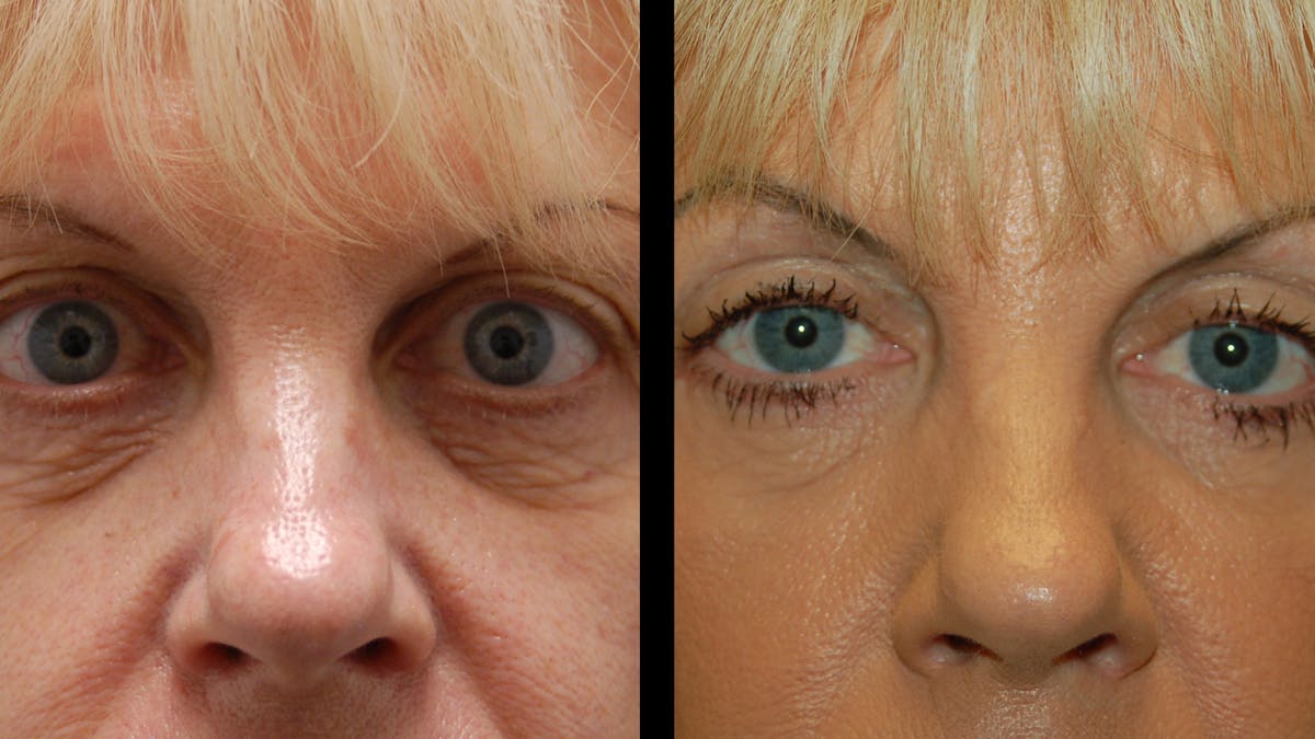 Upper & Lower Eyelid Surgery Before & After Gallery - Patient 176374 - Image 6