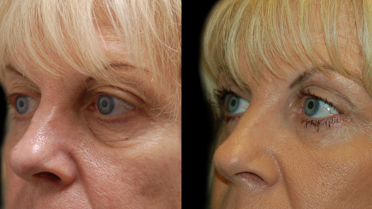 Upper & Lower Eyelid Surgery Before & After Gallery - Patient 176374 - Image 7