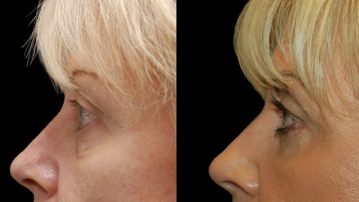 Upper & Lower Eyelid Surgery Before & After Gallery - Patient 176374 - Image 8