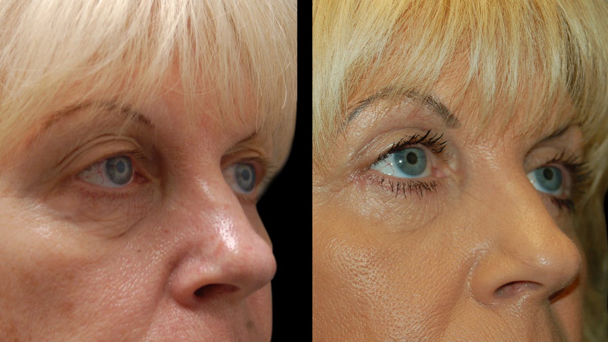 Upper & Lower Eyelid Surgery Before & After Gallery - Patient 176374 - Image 9
