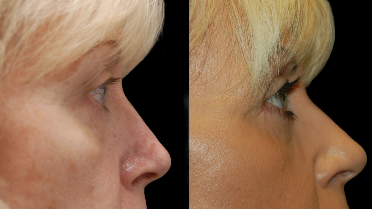 Upper & Lower Eyelid Surgery Before & After Gallery - Patient 176374 - Image 10