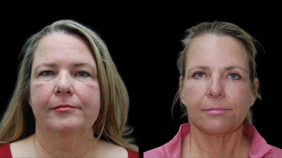 Upper & Lower Eyelid Surgery Before & After Gallery - Patient 437286 - Image 1