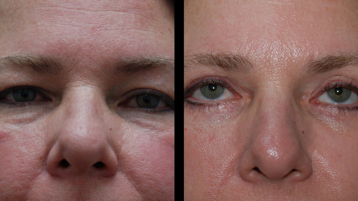 Upper & Lower Eyelid Surgery Before & After Gallery - Patient 437286 - Image 2