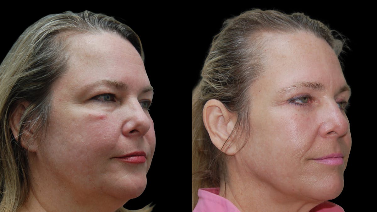 Upper & Lower Eyelid Surgery Before & After Gallery - Patient 437286 - Image 3