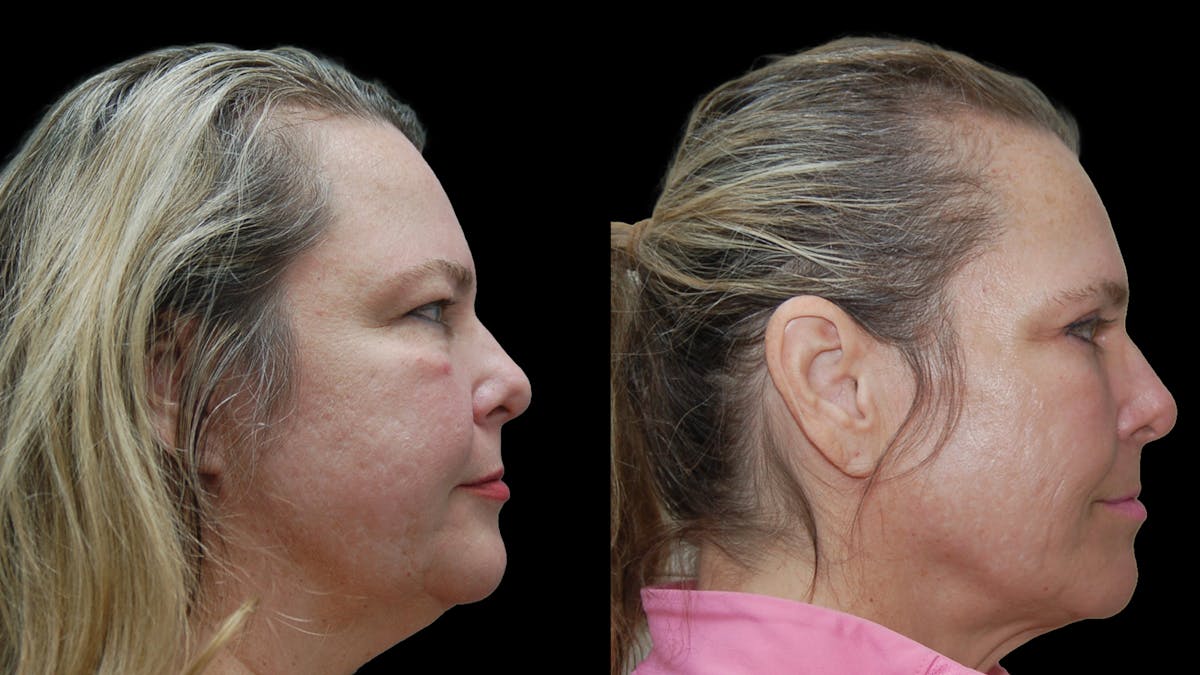 Upper & Lower Eyelid Surgery Before & After Gallery - Patient 437286 - Image 4