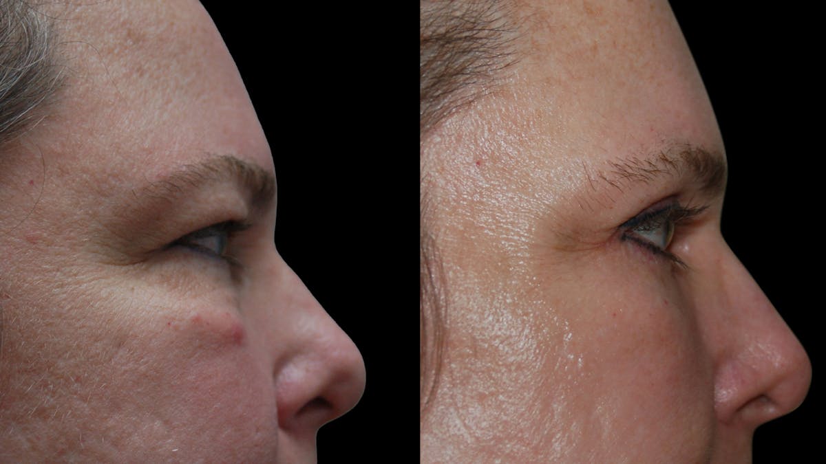 Upper & Lower Eyelid Surgery Before & After Gallery - Patient 437286 - Image 5