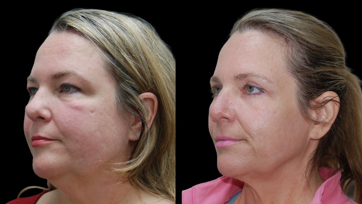 Upper & Lower Eyelid Surgery Before & After Gallery - Patient 437286 - Image 6