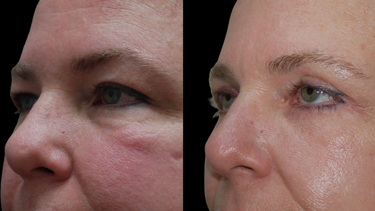 Upper & Lower Eyelid Surgery Before & After Gallery - Patient 437286 - Image 7