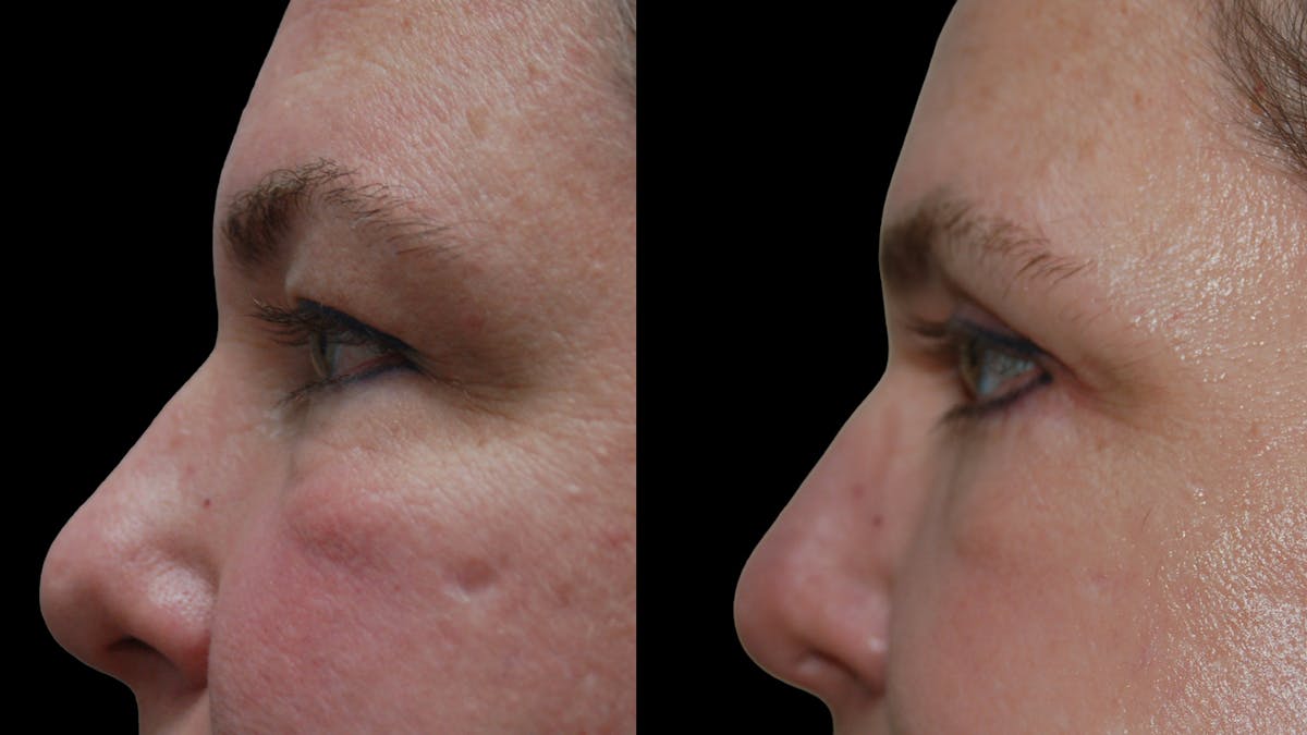 Upper & Lower Eyelid Surgery Before & After Gallery - Patient 437286 - Image 8