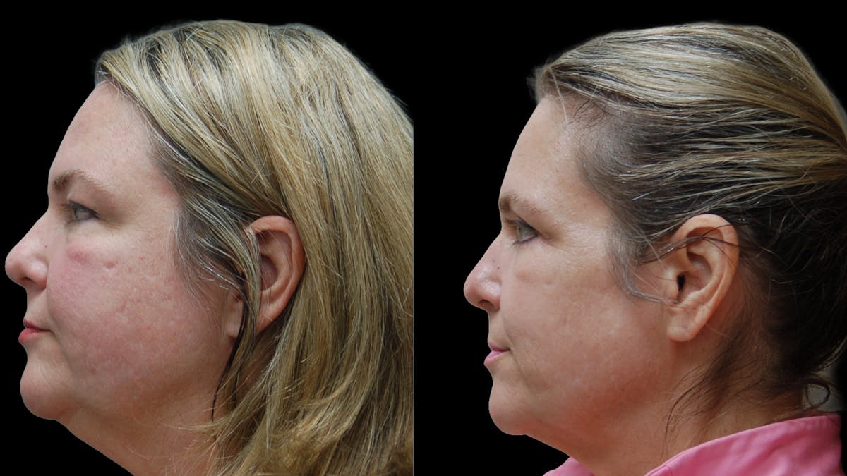 Upper & Lower Eyelid Surgery Before & After Gallery - Patient 437286 - Image 9