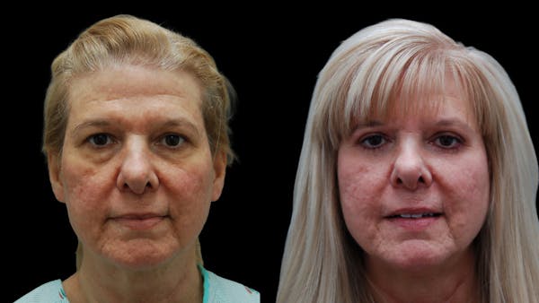 Upper & Lower Eyelid Surgery Before & After Gallery - Patient 625730 - Image 1