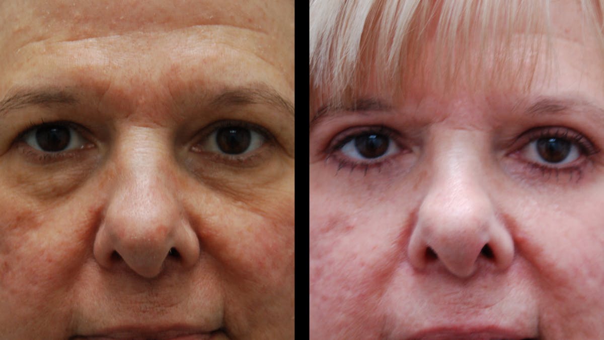Upper & Lower Eyelid Surgery Before & After Gallery - Patient 625730 - Image 2