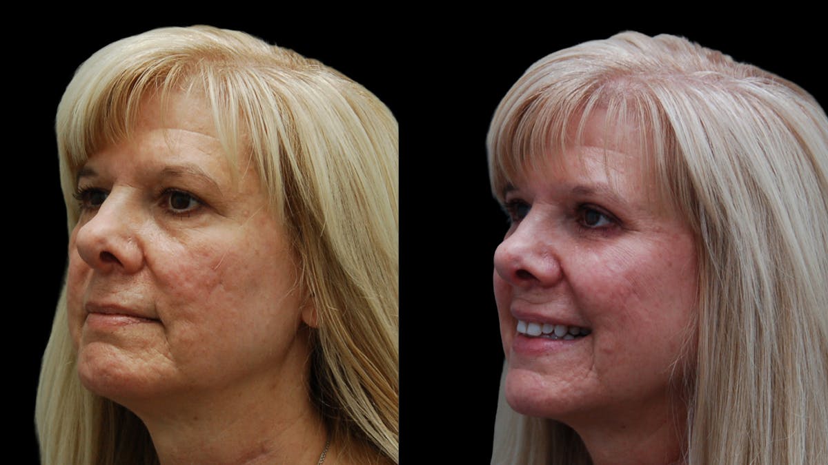 Upper & Lower Eyelid Surgery Before & After Gallery - Patient 625730 - Image 3