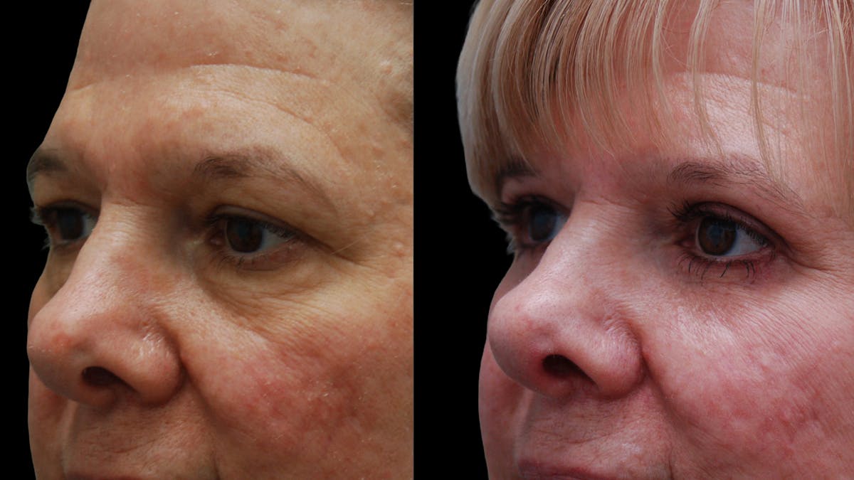 Upper & Lower Eyelid Surgery Before & After Gallery - Patient 625730 - Image 4