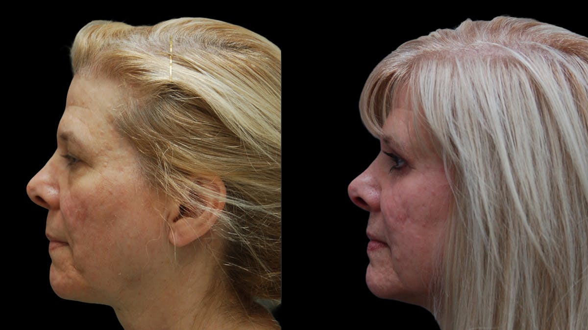 Upper & Lower Eyelid Surgery Before & After Gallery - Patient 625730 - Image 5