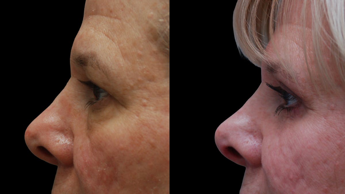 Upper & Lower Eyelid Surgery Before & After Gallery - Patient 625730 - Image 6