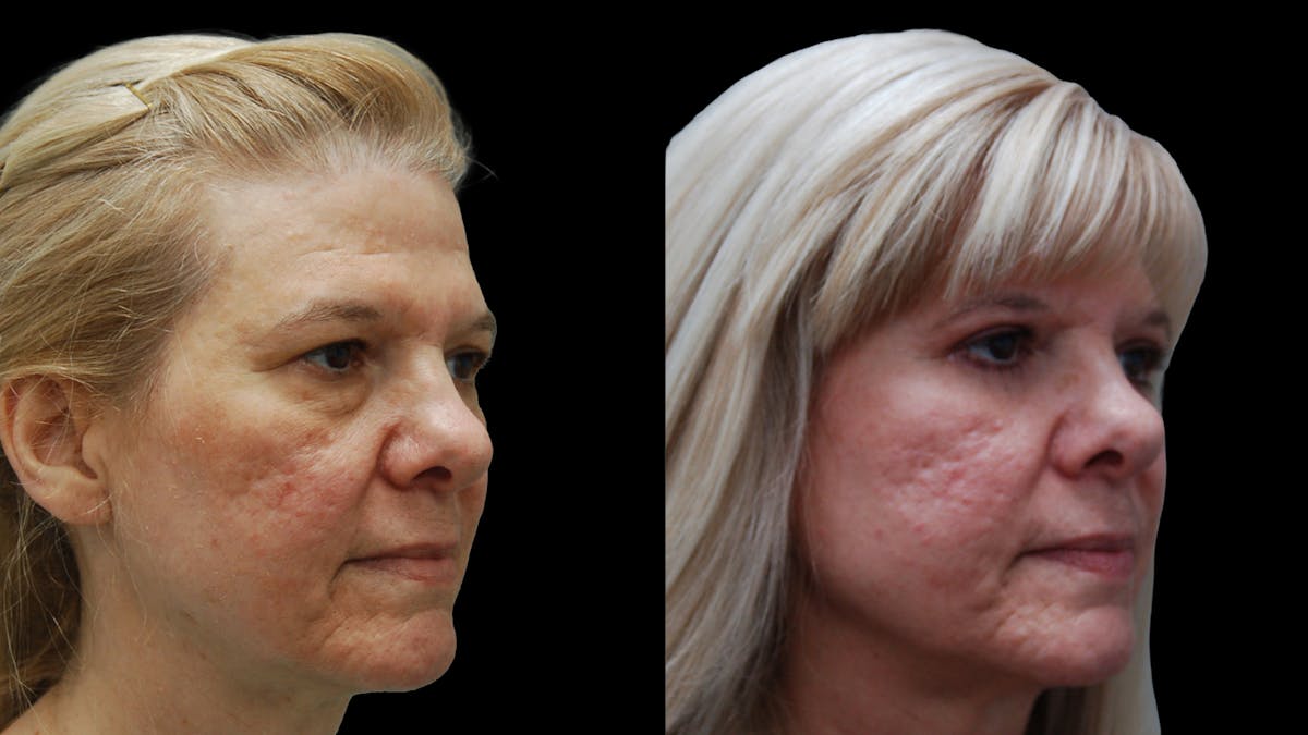 Upper & Lower Eyelid Surgery Before & After Gallery - Patient 625730 - Image 7