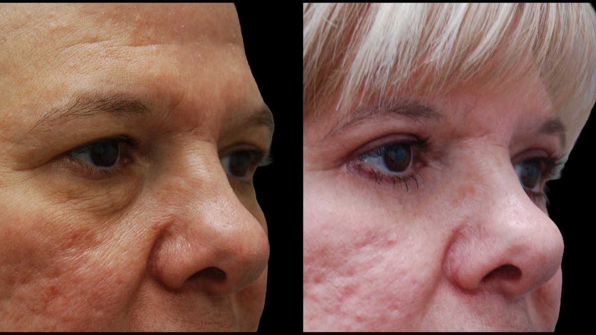 Upper & Lower Eyelid Surgery Before & After Gallery - Patient 625730 - Image 8