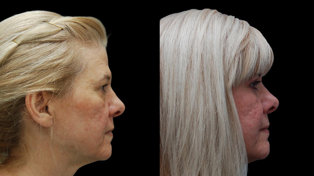 Upper & Lower Eyelid Surgery Before & After Gallery - Patient 625730 - Image 9
