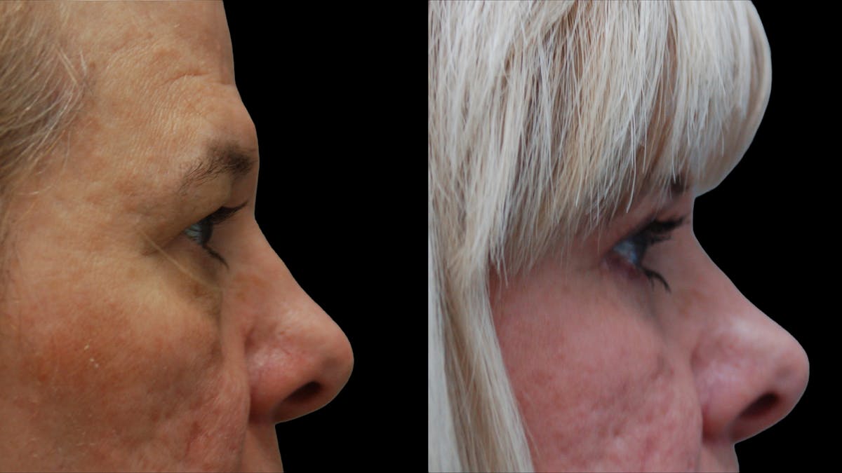 Upper & Lower Eyelid Surgery Before & After Gallery - Patient 625730 - Image 10