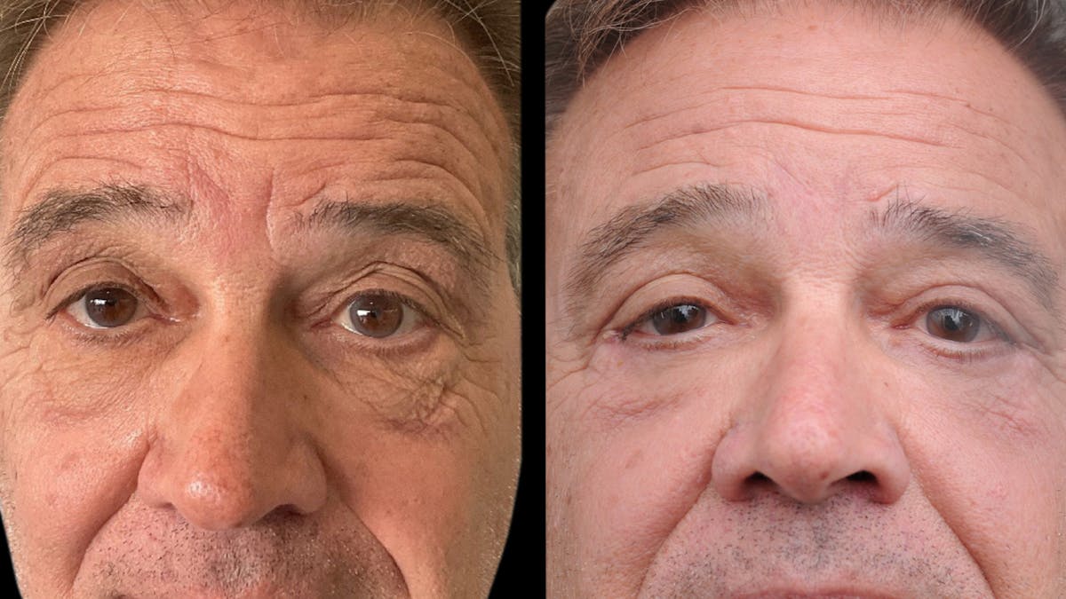 Upper & Lower Eyelid Surgery Before & After Gallery - Patient 147620 - Image 1