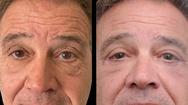 Upper & Lower Eyelid Surgery Before & After Gallery - Patient 147620 - Image 1