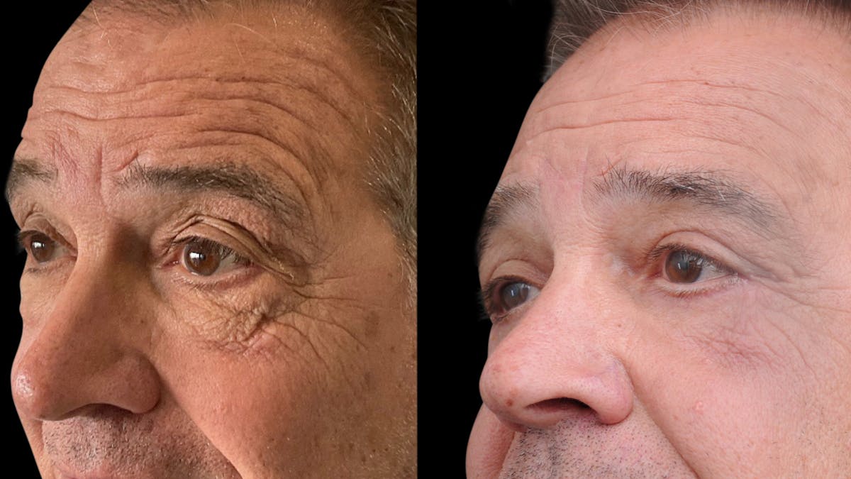 Upper & Lower Eyelid Surgery Before & After Gallery - Patient 147620 - Image 2