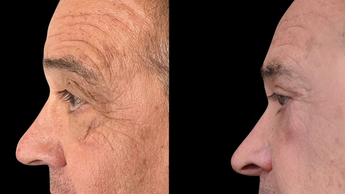 Upper & Lower Eyelid Surgery Before & After Gallery - Patient 147620 - Image 3